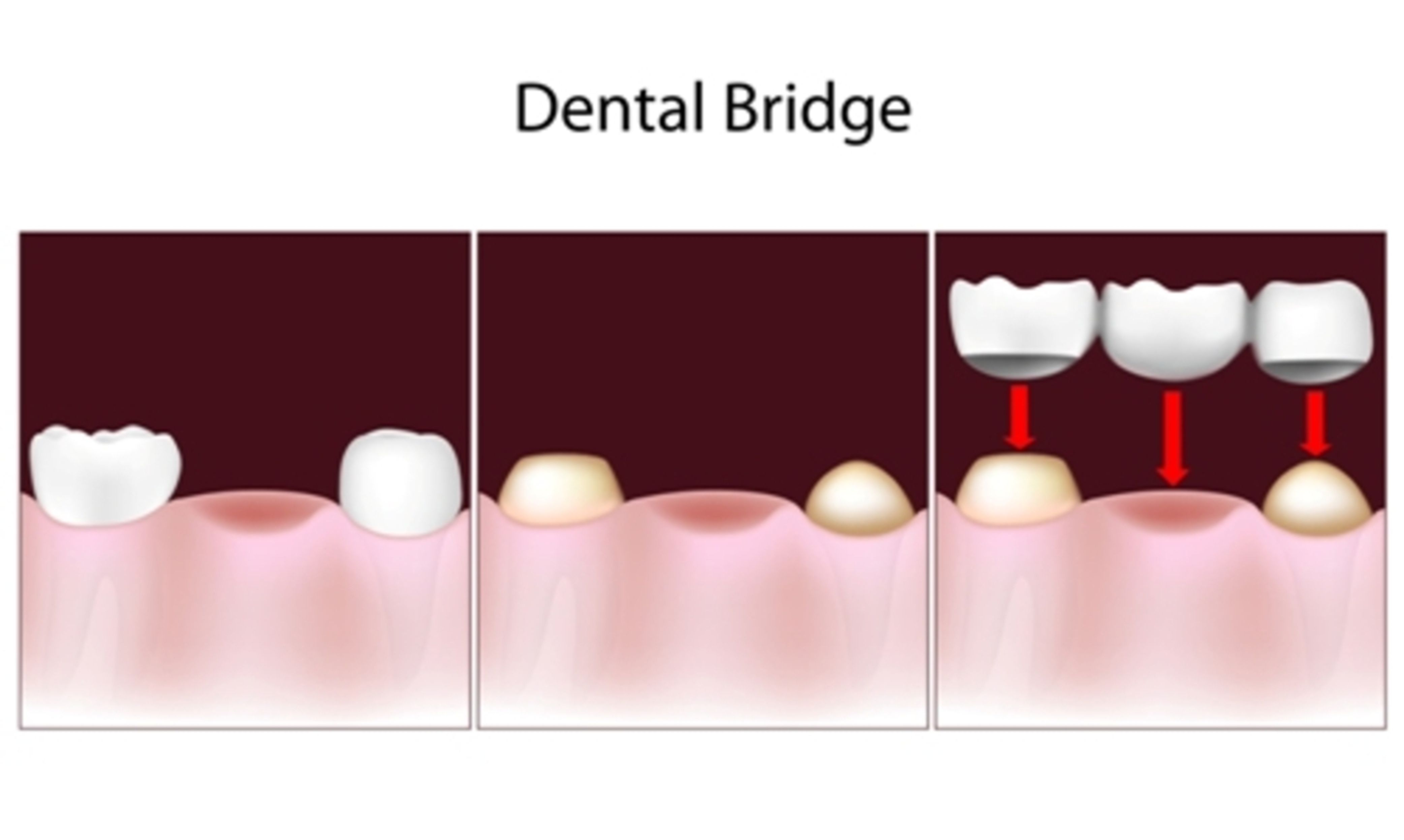 putting-a-dental-bridge-in-position-ankeny-ia