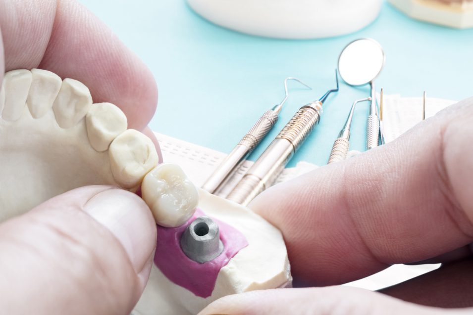 Prosthodontics at Bayview Village Dental